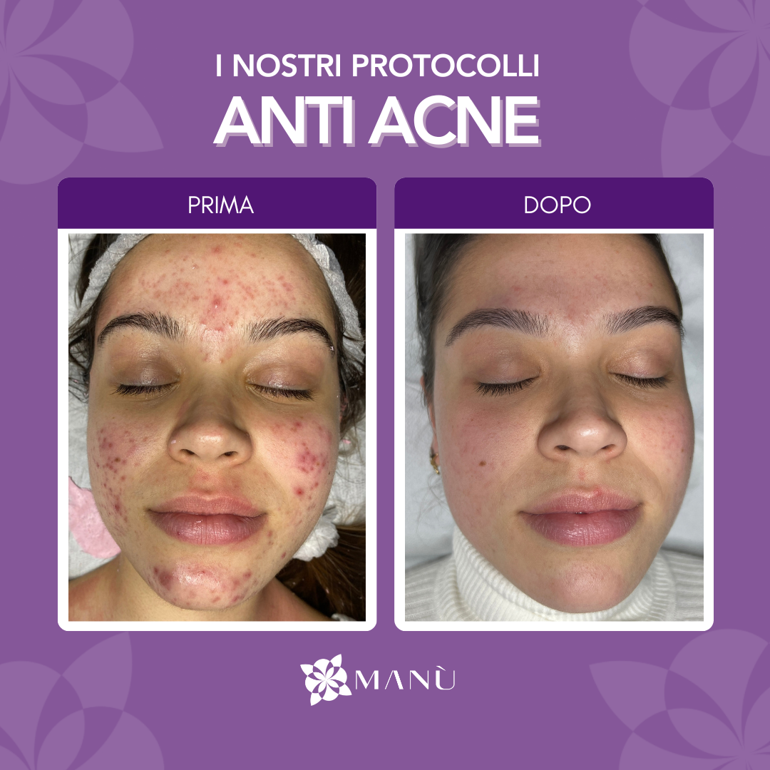 PROTOCOLLO ANTIACNE CAGLIARI