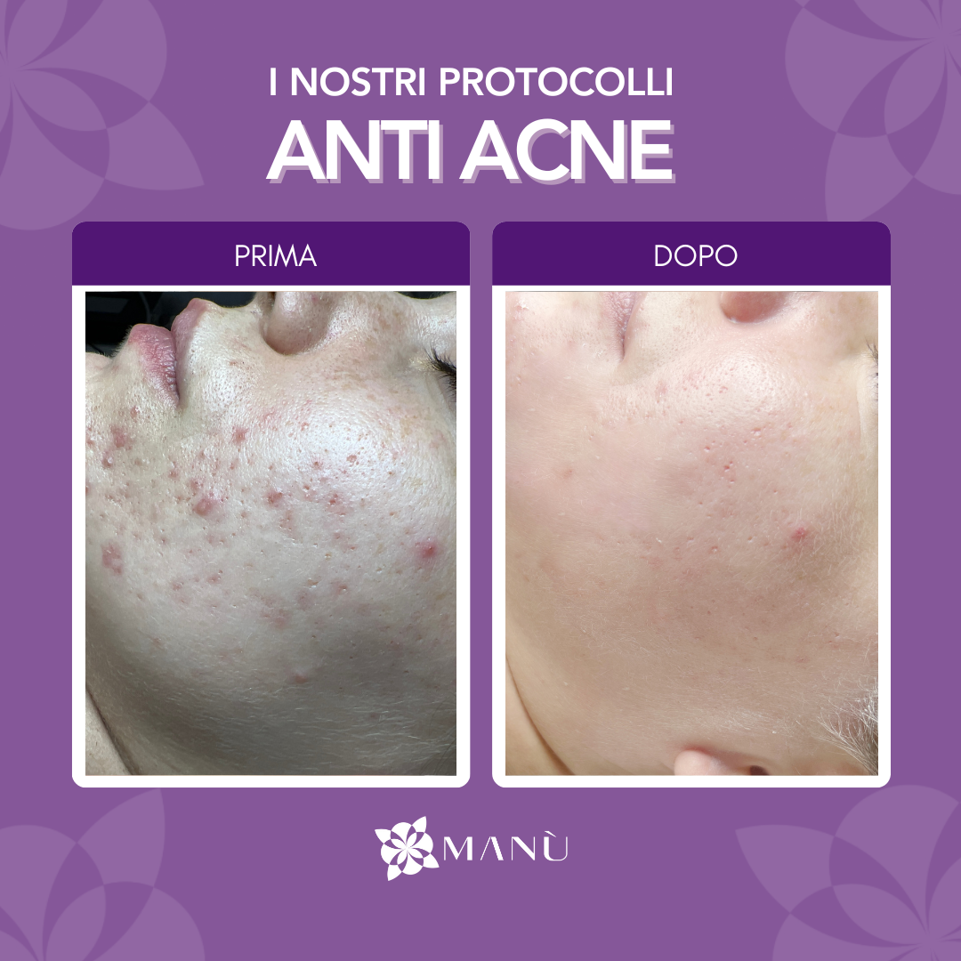 PROTOCOLLO ANTIACNE CAGLIARI