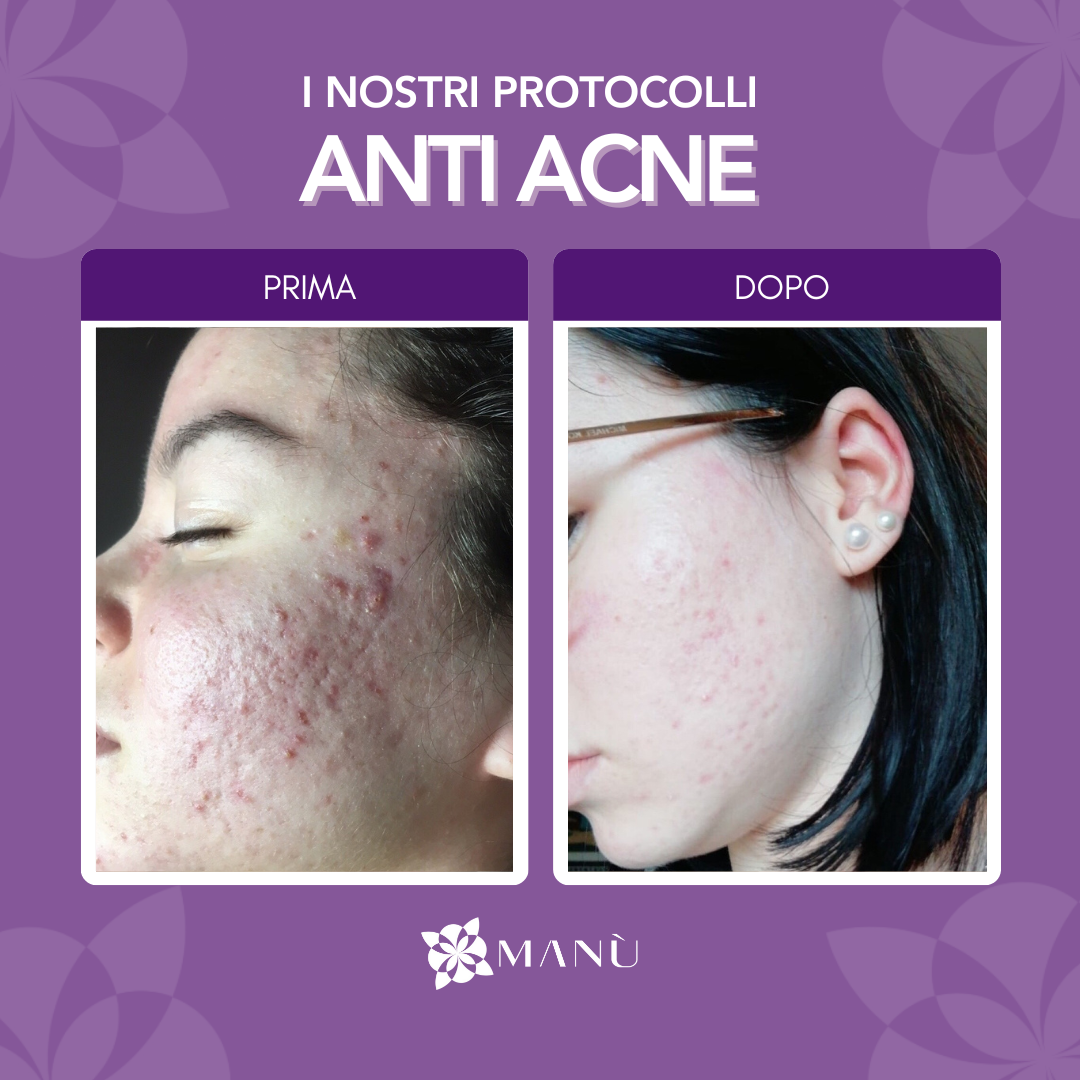 PROTOCOLLO ANTIACNE CAGLIARI
